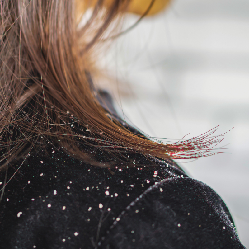 Seborrheic Dermatitis vs. Dandruff: Are They Actually the Same Thing?