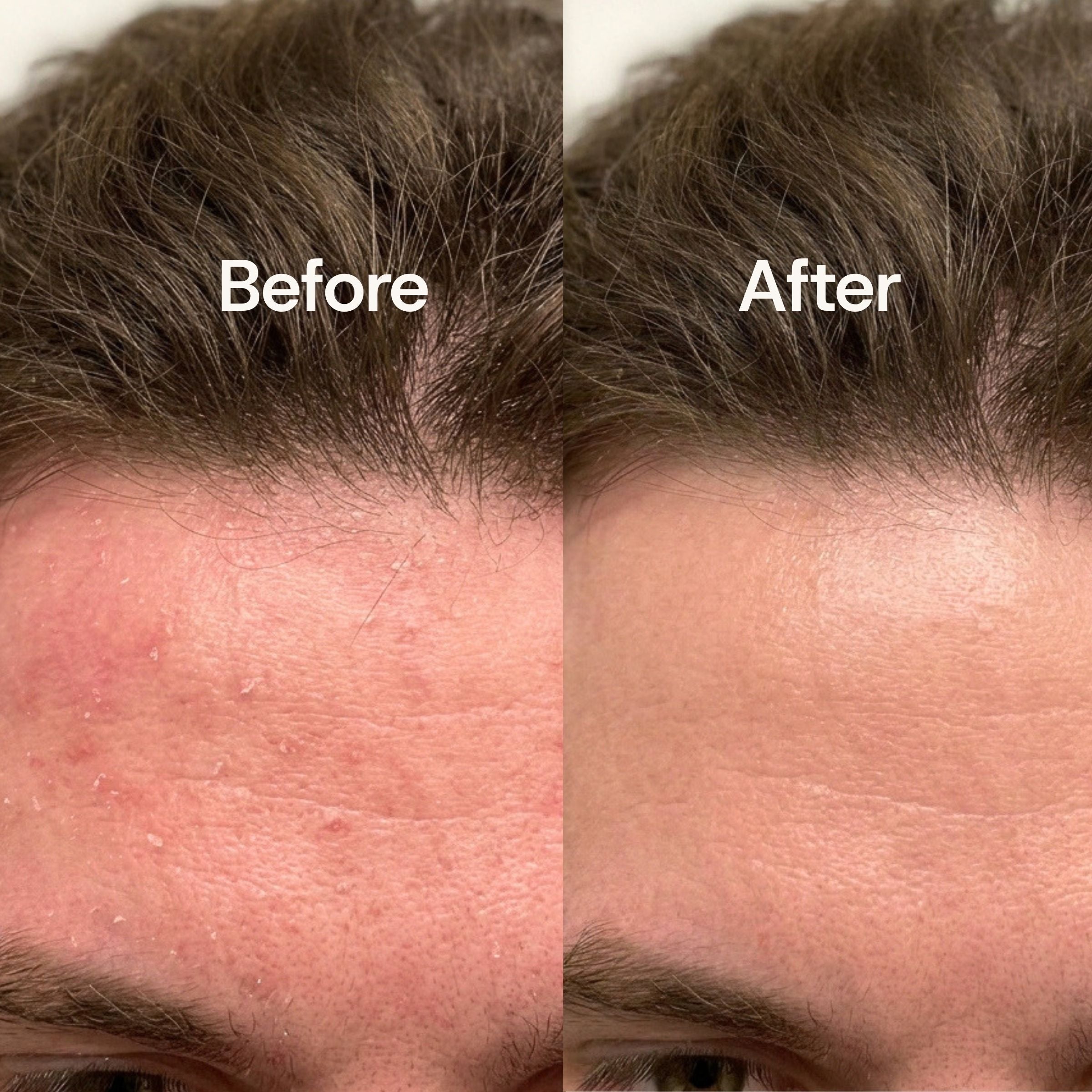 A split-screen close-up of a man's forehead labeled 'Before' on the left and 'After' on the right, showing skin texture and appearance improvement with dark brown hair above.