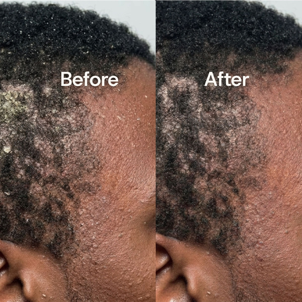 Hairline & temple