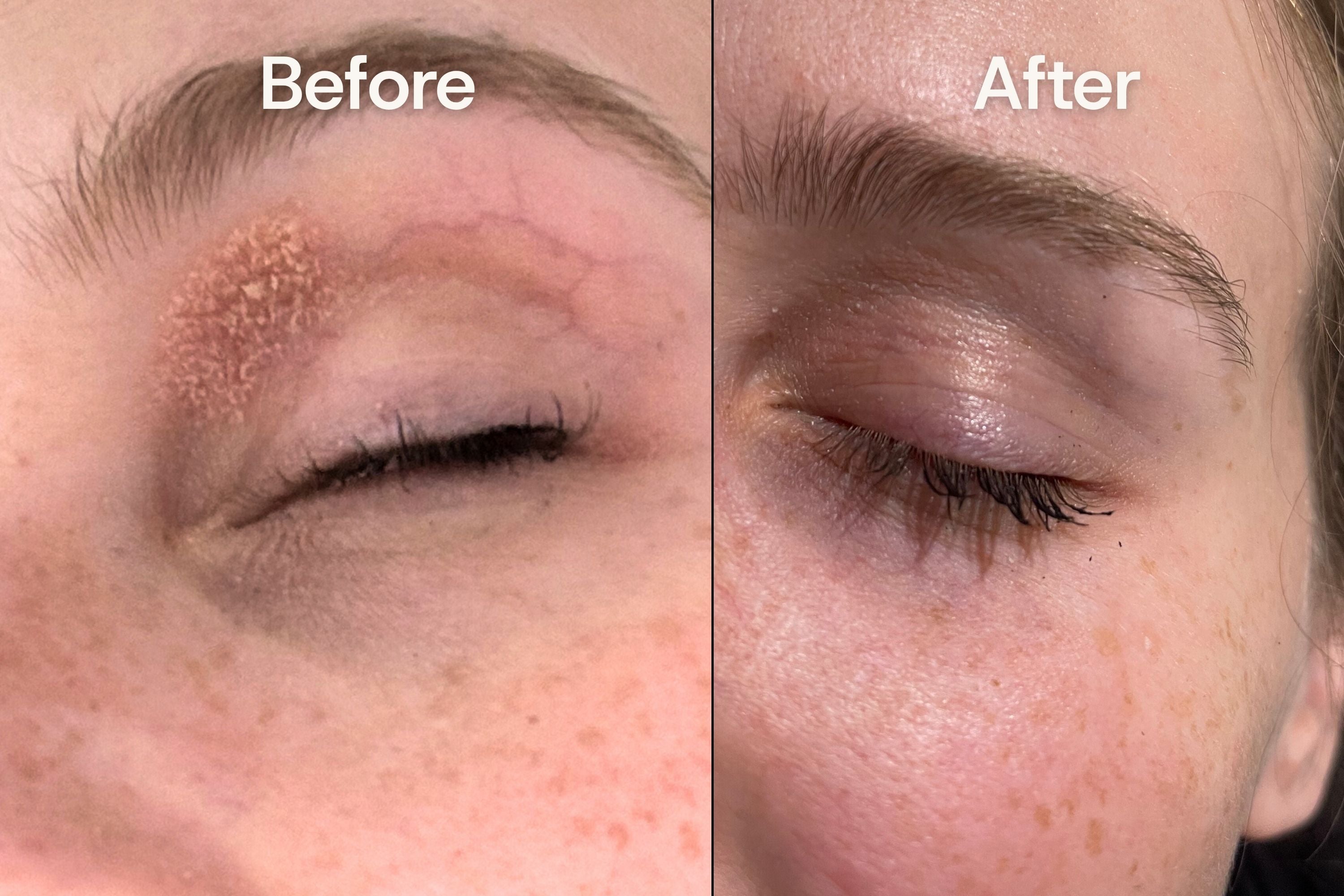Before and after comparison of seborrheic dermatitis on a person's eyelid.