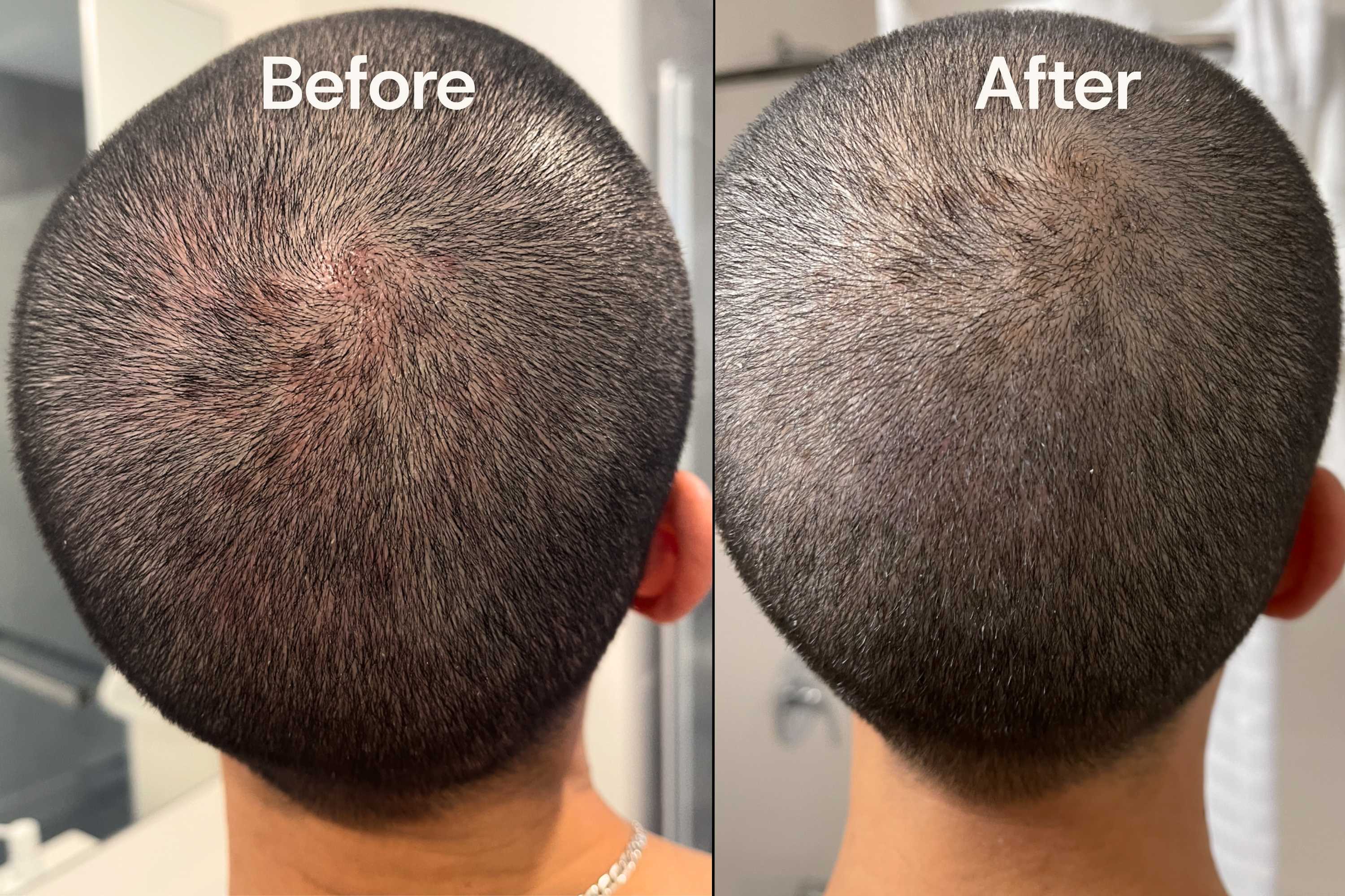 Before and after comparison of a person's scalp after using octaskin serum.