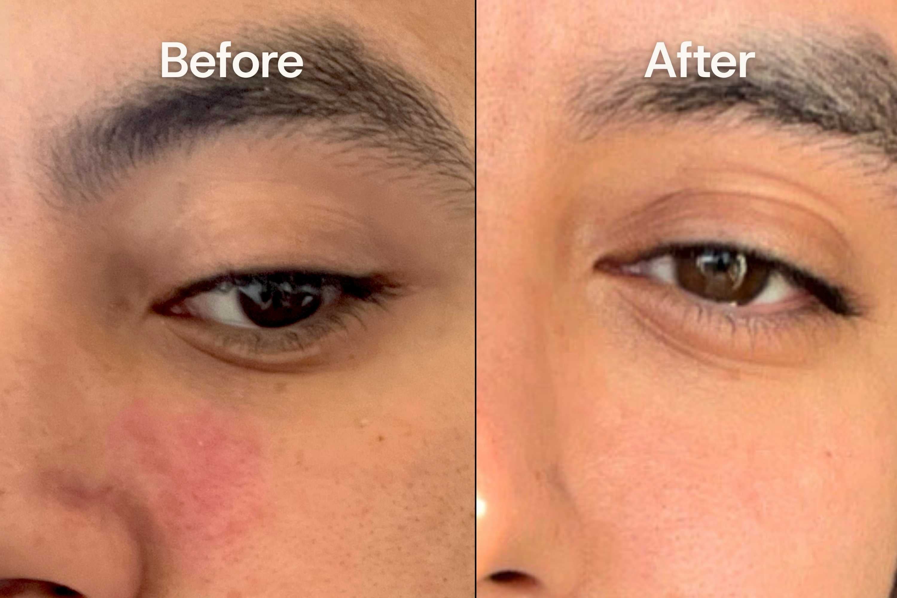 Before and after comparison of a person's eye area with a focus on skin texture and redness.