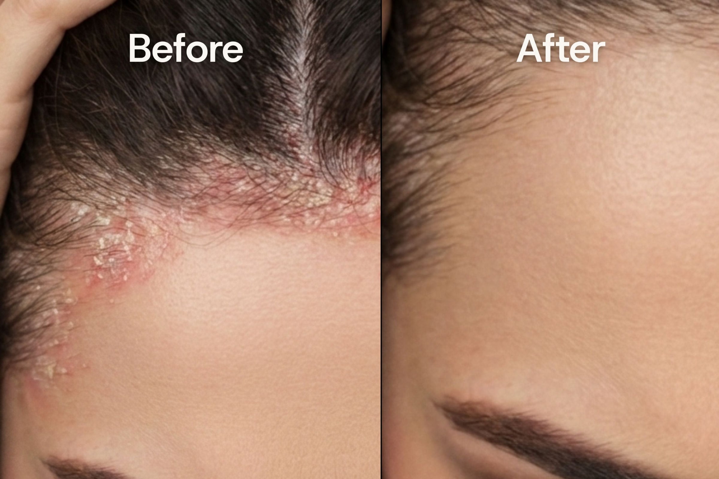 Before and after comparison of scalp condition (seborrheic dermatitis) on a person's head.