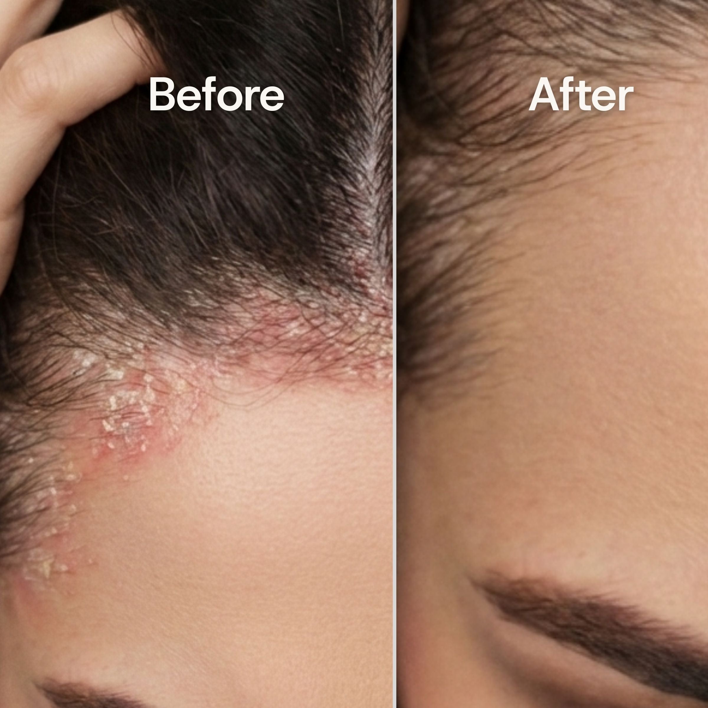 Before and after comparison of seborrheic dermatitis scalp condition